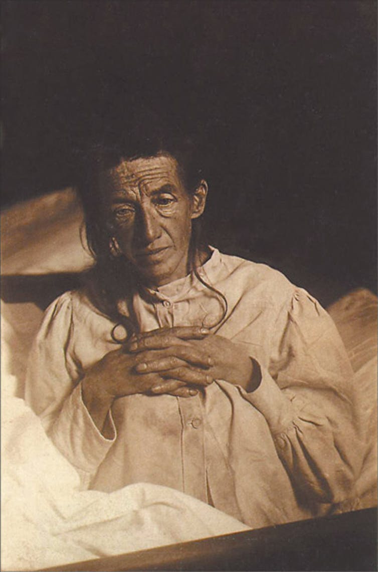 Alois Alzheimer’s patient Auguste Deter in 1902. Hers was the first described case of what became known as Alzheimer’s disease. Wikimedia